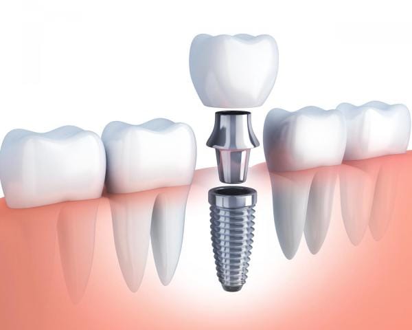 dental implants Dental implant restored with a crown.