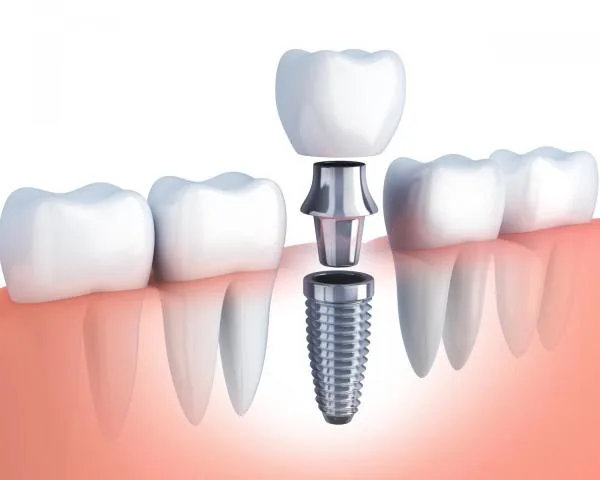 dental implants Dental implant restored with a crown.